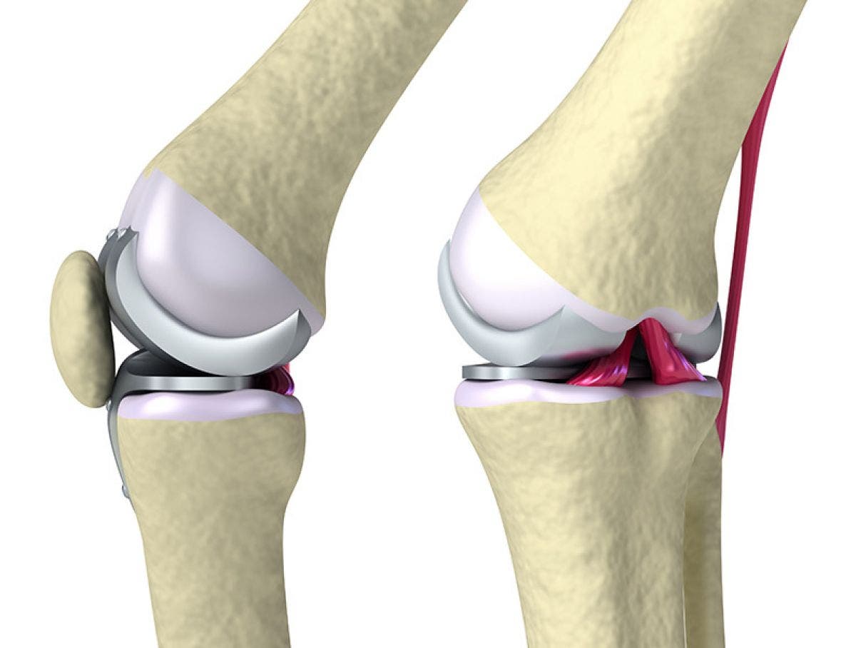 Rehabilitacion rodilla en piscina